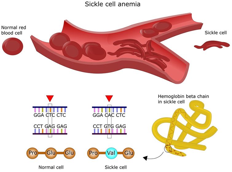 primary research article on sickle cell anemia